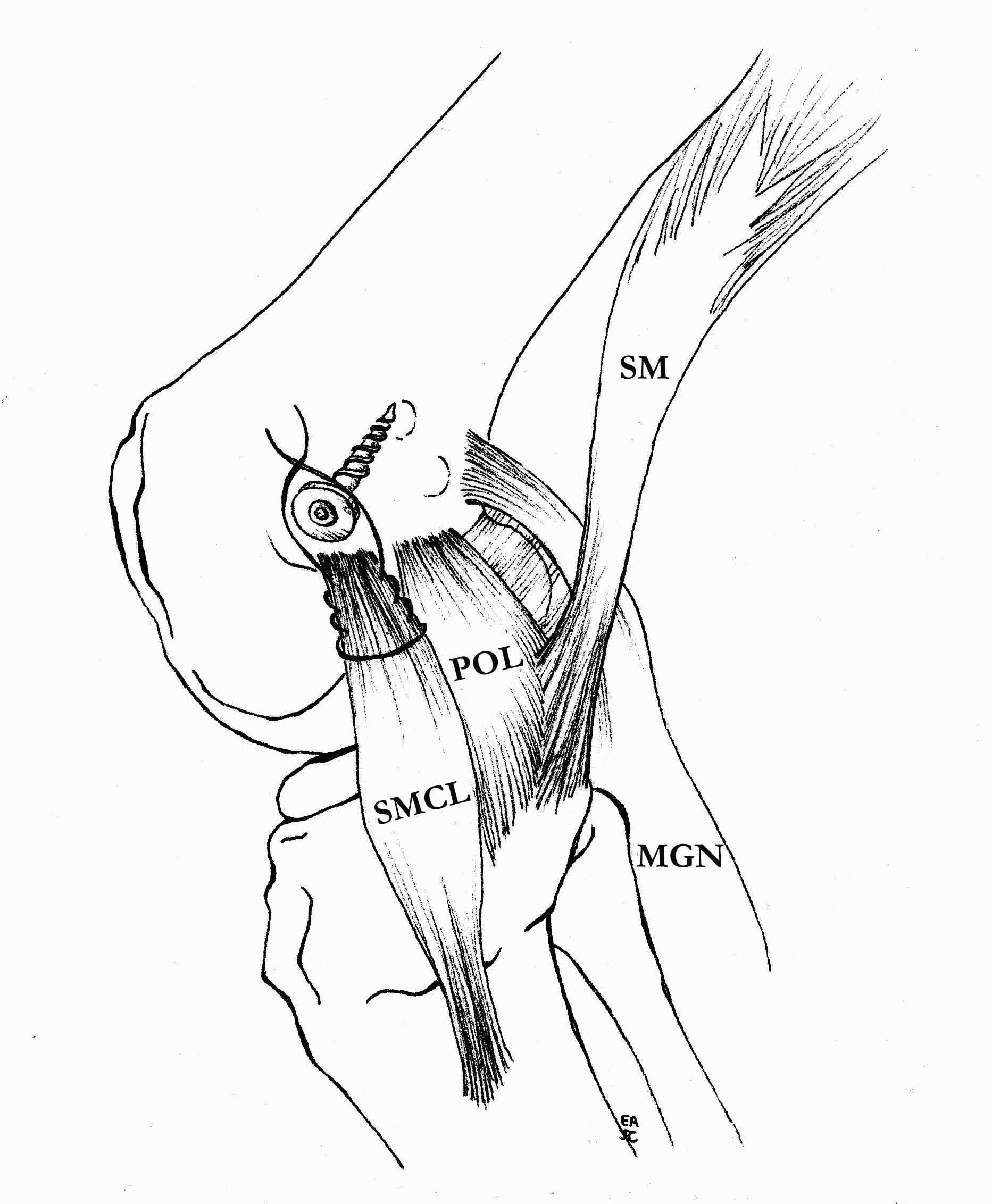 Proximal MCL Advancemetn 1